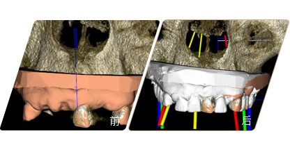 數(shù)字化種植牙設(shè)計(jì)軟件前后對比