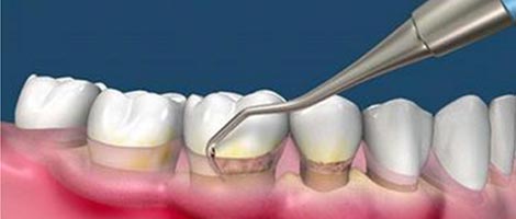 輕度牙周病治療方案齦下潔治