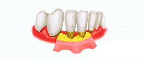 中重度牙周病方案翻瓣手術